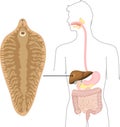 Sheep liver fluke Fasciola hepatica and structure of human digestive system. Location of helminth in body